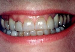 Before and After with Porcelain Veneers and Crowns