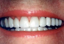 Before and After with Porcelain Veneers and Crowns